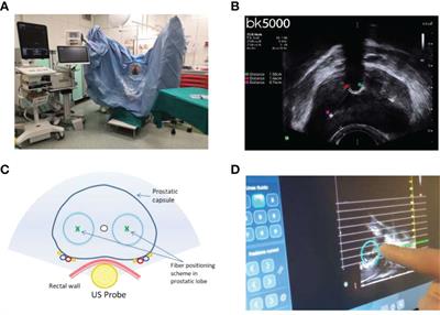Transperineal laser ablation of the prostate with EchoLaser™ system: perioperative and short-term functional and sexual outcomes